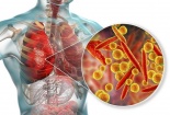 Viêm phổi do vi khuẩn Mycoplasma pneumoniae gia tăng ở trẻ em