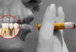 Gia tăng các bệnh lý về răng miệng khi thường xuyên sử dụng thuốc lá 