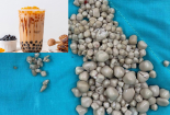 Nhập viện gắp 300 viên sỏi thận nghi do uống trà sữa thay nước lọc