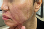 Bỏng nặng vùng mặt do peel da trị nám sai cách tại một spa 