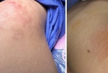 Gánh hậu quả nghiêm trọng sau khi tiêm filler cải thiện vòng 3