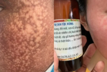 Mua mỹ phẩm trên mạng làm đẹp cấp tốc ăn tết nguy cơ biến chứng khó lường