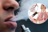Sử dụng thuốc lá điện tử trong phòng kín thường xuyên có thể dẫn đến tổn thương phổi cấp