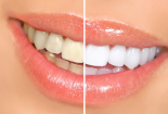 Chưa có bằng chứng khoa học chứng minh dùng oxy già tẩy trắng răng hiệu quả