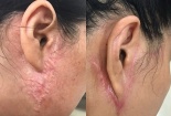 Những hiểm họa khó lường khi phẫu thuật thẩm mỹ căng da mặt