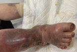 Lạm dụng thuốc corticoid tổng hợp gây suy tuyến thượng thận, nhiễm trùng nặng