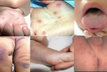Sở Y tế TP.Hà Nội cảnh báo dịch tay chân miệng gia tăng