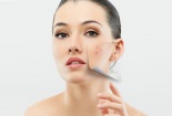 Các thành phần nên có khi lựa chọn kem dưỡng ẩm dành cho da dầu mụn