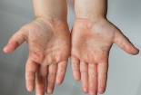 Người dân lưu ý phòng ngừa bệnh tay chân miệng đang có chiều hướng gia tăng tại phía Nam