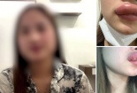 Dịch vụ tuyển mẫu tiêm filler giá rẻ tại các cơ sở thẩm mỹ liệu có an toàn?
