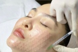 Rủi ro từ tiêm mesotherapy trẻ hoá da cấp tốc