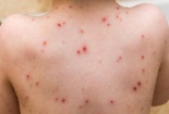 WHO tuyên bố bệnh Mpox là tình trạng y tế công cộng khẩn cấp toàn cầu