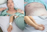 Tự ý dùng thuốc điều trị đau khớp, người đàn ông mắc hội chứng Dress thể dị ứng thuốc hiếm gặp
