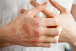 Những dịch bệnh thường gặp sau mùa mưa lũ