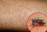 Hà Nội ghi nhận nhiều ca sốt xuất huyết Dengue
