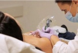 Hoại tử ngực sau khi xăm làm hồng ở một spa từ quảng cáo trên mạng