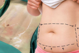 Cẩn trọng với những quảng cáo 'nổ' hình ảnh cắt cả mảng mỡ bụng để giảm cân trên mạng 