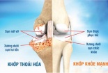 Thói quen tưởng vô hại lại gây ảnh hưởng nghiêm trọng đến khớp