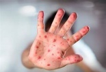 Sở Y tế TP.HCM: HMPV không phải virus mới, từng được phát hiện từ năm 2023