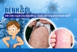 Bộ Y tế ra công văn hỏa tốc về phòng, chống bệnh sởi