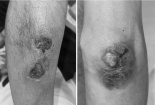 Ngộ độc methotrexate: Sai một liều, trả giá bằng sức khỏe
