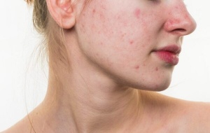 Người tiêu dùng cần lưu ý khi sử dụng kem chống nắng nếu da đang bị mụn