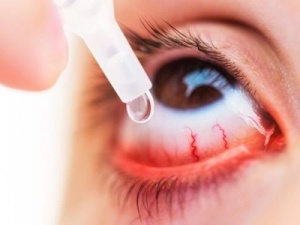Lạm dụng corticoid nhỏ mắt có thể làm tăng nguy cơ mắc glaucoma gây mù vĩnh viễn