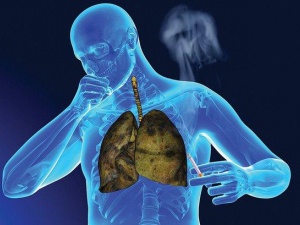 Mỹ cấp phép thuốc có thể 'điều khiển' hệ miễn dịch cơ thể để tiêu diệt tế bào ung thư phổi