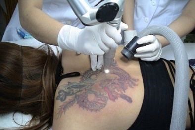 Thuốc xóa hình xăm của Trung Quốc tràn lan thị trường