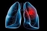 Bào chế thành công vắcxin phòng ung thư phổi