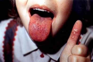 Bệnh tay chân miệng đã có vaccin đặc trị