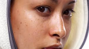 Da mất màu vì mỹ phẩm tẩy nám