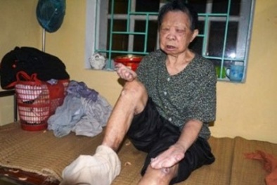 Làm rõ hành vi ‘ăn bớt’ thuốc bệnh nhân phong ở Hà Nội