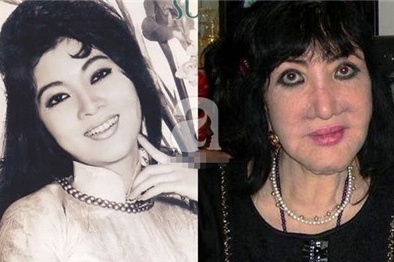 Đi phẫu thuật làm đẹp: Người đẹp Thẩm Thúy Hằng bị 'biến dạng'