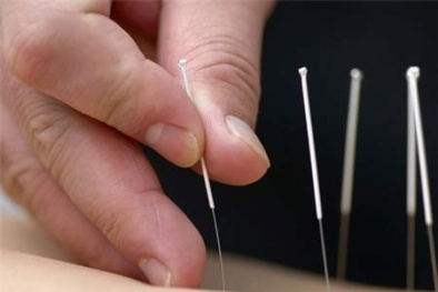 Châm cứu: coi chừng châm xong cấp cứu