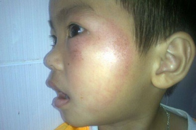 Trẻ mầm non bị mẹ hiệu trưởng đánh bầm dập ở trường