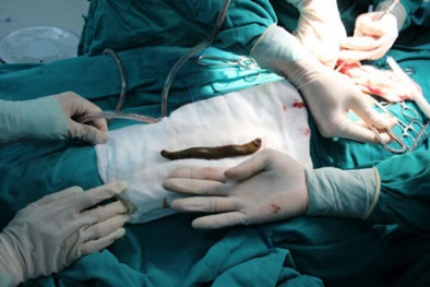 Đỉa 5 cm sống trong khí quản, cá bơi trong phổi bé trai