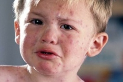 Cách phân biệt bệnh sởi với sốt phát ban