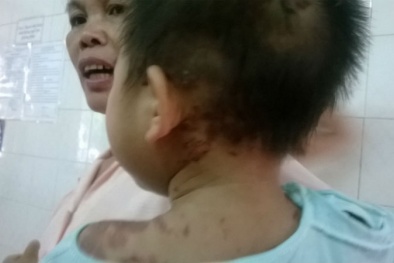 Uống thuốc xong trẻ sùi bọt mép, co giật, bỏng da toàn thân