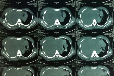 Mang khối u khổng lồ vẫn mang thai sinh con