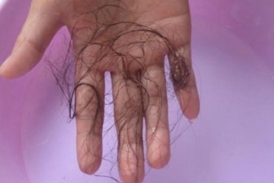 Tóc giả Trung Quốc gây rụng tóc hàng loạt