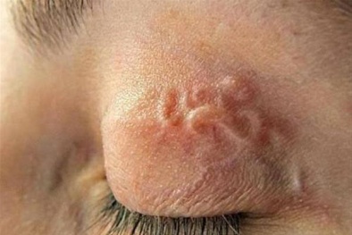 Vướng bệnh vì lười vệ sinh cá nhân