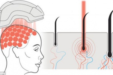 Mũ bảo hiểm giúp mọc tóc