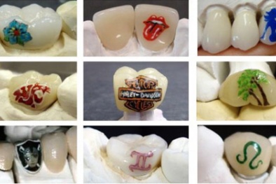 Xăm răng: Trào lưu cầu kì và nguy hiểm