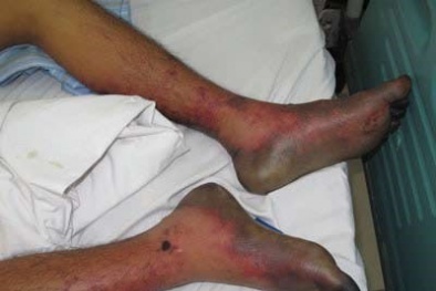 Món chạo làm từ xương, thịt lợn sống: Viêm não viếng thăm