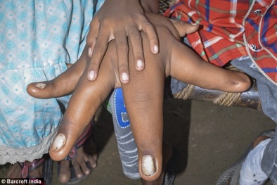 Bàn tay khổng lồ của cậu bé 8 tuổi