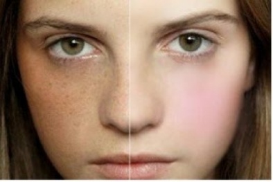 Mẹo hay xóa sạch nhanh chóng tàn nhang trên khuôn mặt