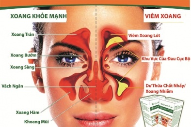 Thảo dược gia truyền trị dứt điểm viêm xoang và viêm mũi
