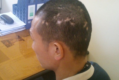  Trùm bảo kê Thà 'rồng' dính đầy sẹo vì trộm chó