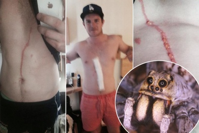 Phát hiện trường hợp bị nhện nhiệt đới làm tổ trên cơ thể